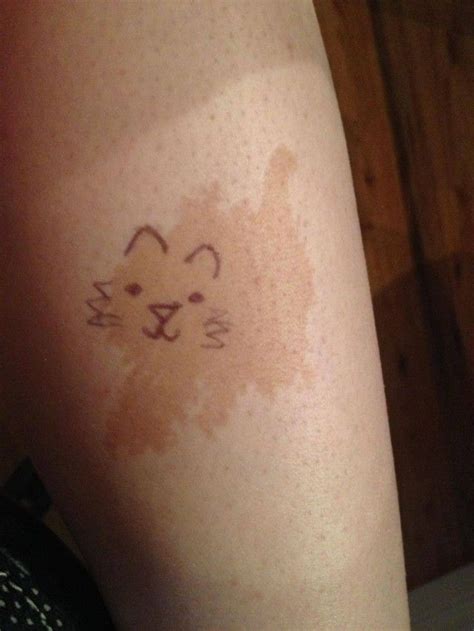 10 Amazing Birthmarks You Have To See To Believe Birthmark Tattoo
