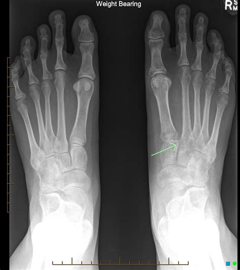 A lisfranc injury is a significant injury that involves the midfoot. Missed Lisfranc fracture | Image | Radiopaedia.org