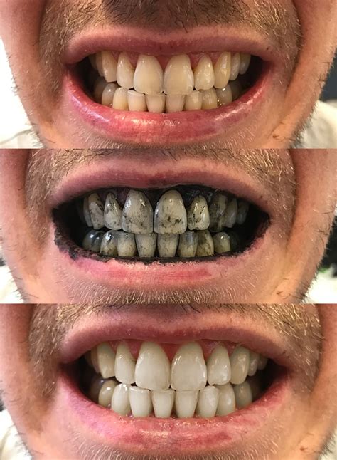 Mr Black Charcoal Teeth Whitening