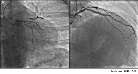 Arterial embolism of the extremities and technique of embolectomy. Trombosis coronaria en paciente con tratamiento ...