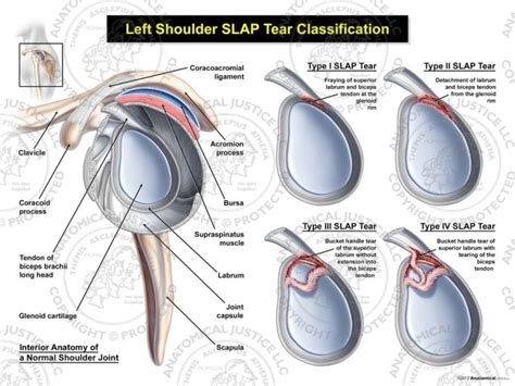 Slap 병변의 이학적 검사법 관절와순파열 검사 네이버 블로그