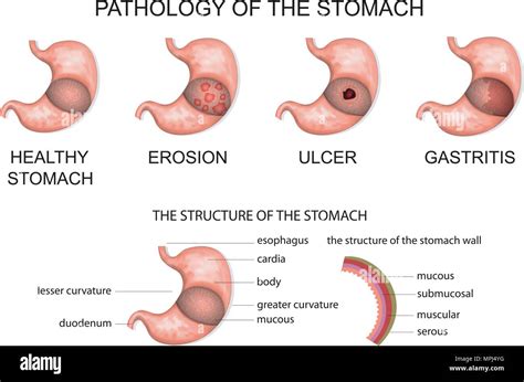 Erosion Of The Stomach Hi Res Stock Photography And Images Alamy