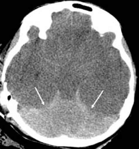 Reversal Sign Axial Noncontrast Ct Scan Of The Brain In A Child With