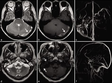 Pearls And Pitfalls In The Magnetic Resonance Diagnosis Of Dural Sinus