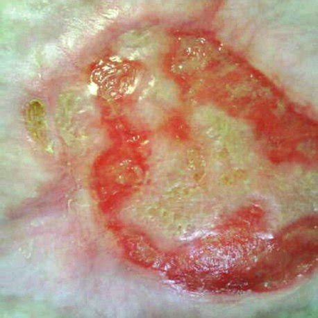 The Wound At Initial Assessment Showing Sloughy Tissue On The Surface