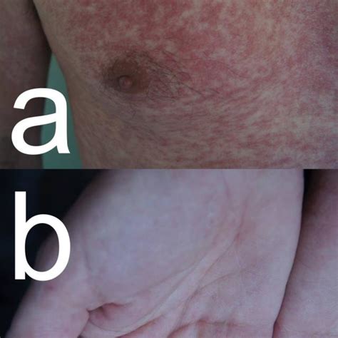 Measles A And B Maculopapular Rash Involvement Of The Palms