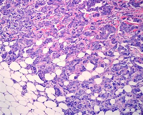 Human Breast Invasive Carcinoma Stock Photo Image Of Histopathology