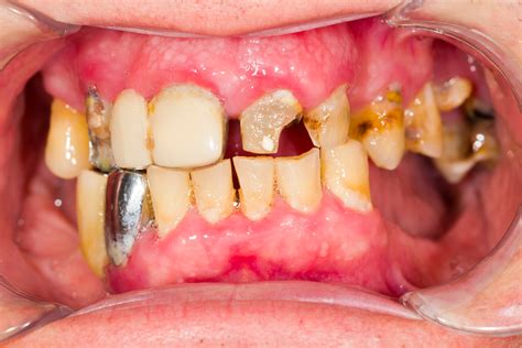 Removable Partials And Dentures Azusa Restorative Dental Ph
