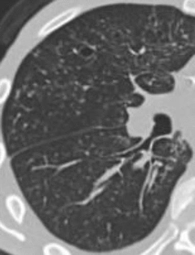 Pulmonary Tuberculosis Role Of Radiology In Diagnosis And Management