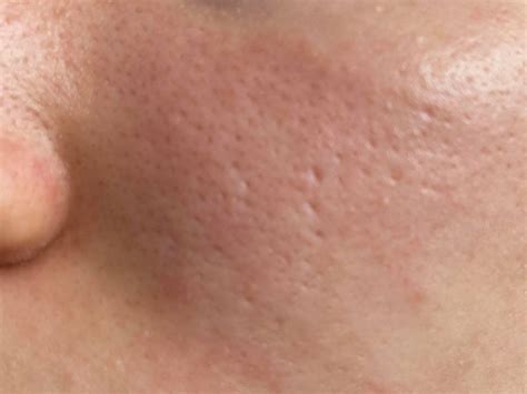 Routine Help Large Pores On Forhead Cheeks And Nose Mild Acne Scars