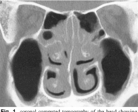 Figure 1 From Nasal Septal Abscess As A Complication Of Laser Inferior