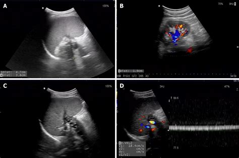 Sinistral Portal Hypertension Associated With Pancreatic Pseudocysts