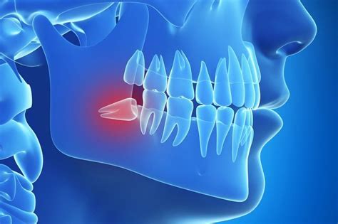 How Long Does It Take For A Wisdom Tooth Extraction To Heal