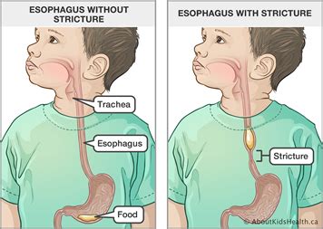 Esophageal Atresia Or Tracheoesophageal Fistula EA TEF Repair How To