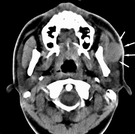 Diagnosis And Treatment Of Accessory Parotid Gland Tumors Journal Of