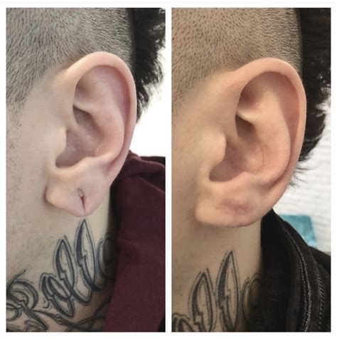 Earlobe Reconstruction Lines And Dots
