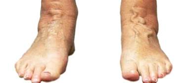 Varicose Veins Feet Might Be All Thats Visible
