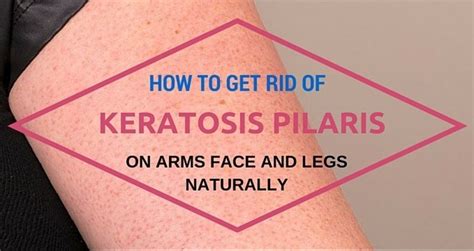 How To Get Rid Of Keratosis Pilaris On Arms Face And Legs Naturally