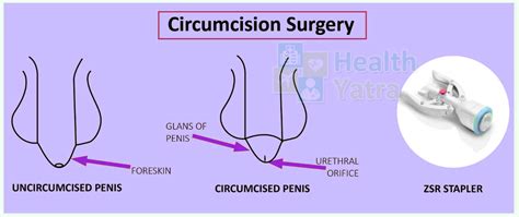 Circumcision Surgery In India Updated 2023