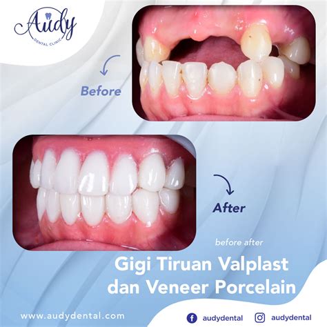 Jenis gigi palsu ini lentur teksturnya, dan dipasang tanpa penggunaan kawat. Gigi Tiruan Lepasan | Audy Dental