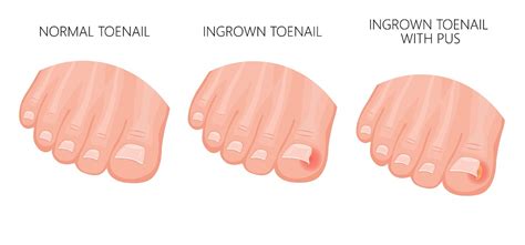 How To Fix An Ingrown Toenail Permanently Podiatrist Home And Surgery Tips