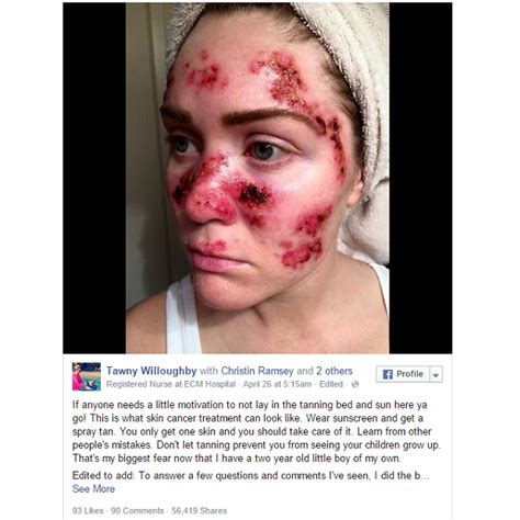 The cancer woman can seem extremely shy at first, even to the point of being uncomfortable making eye contact. Viral: woman shares gruesome skin cancer photo to warn ...