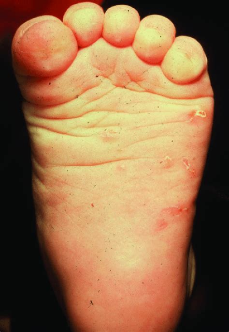 Scabies Burrows On The Feet Of An Infant Download Scientific Diagram