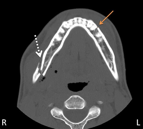 How was that missed? (Mandibular Fracture) - Dr. G's Toothpix