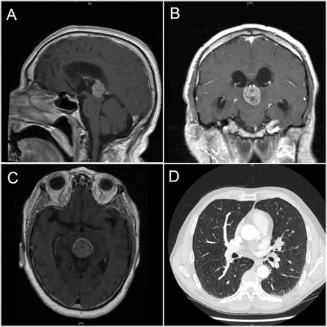 Pulmonary Adenocarcinoma Presenting As A Pineal Gland Mass With