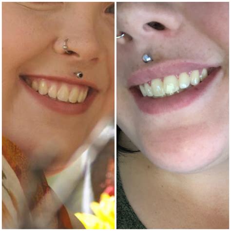 Before And After 4 Units Of Botox To Create A Lip Flip Best 40 Ive