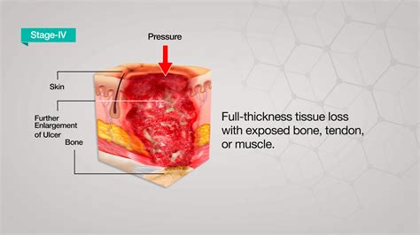 Pressure Ulcer Causes Stages Treatment Axio Biosolutions
