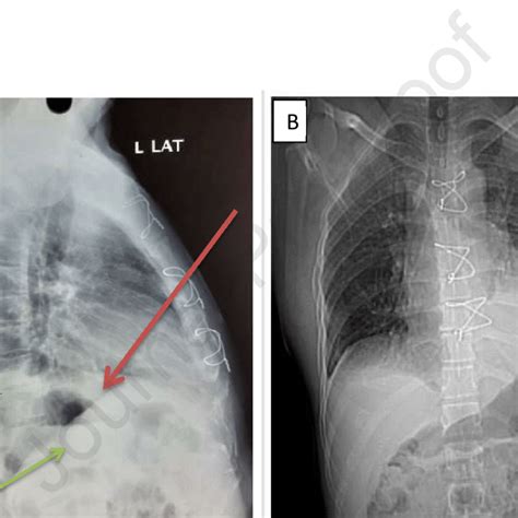A Chest Xray Lateral View Showing Elevated Left Hemidiaphragm Red