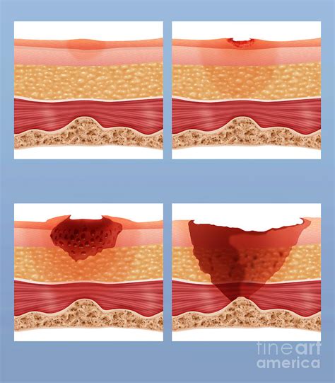 Bed Sores Photograph By Monica Schroeder Science Source