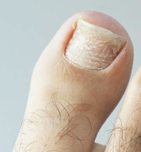 Vicks Vapor Rub Toenail Fungus Foot Doctor Shares Secret Remedy