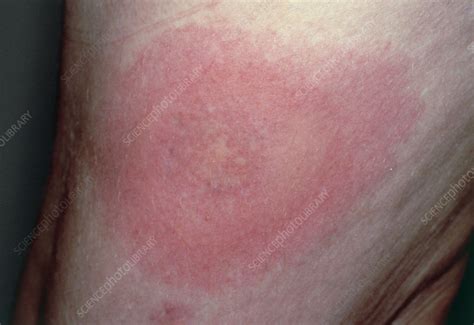 Female Patients Thigh Showing Lyme Disease Rash Stock Image M200