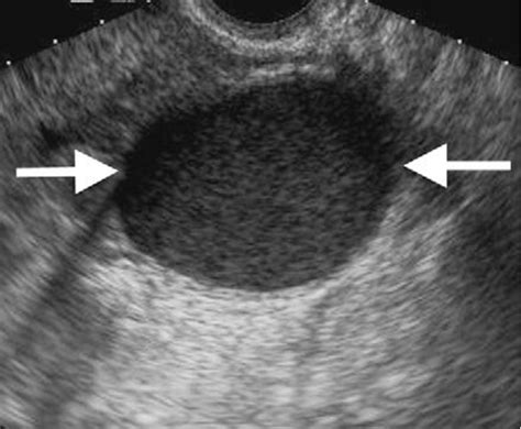 Transvaginal Ultrasound Scan Of A Complex Cystic Solid Ovarian Tumor In Sexiz Pix