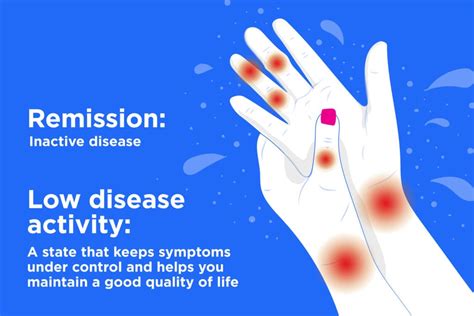 What Remission And Low Disease Activity In Rheumatoid Arthritis Means