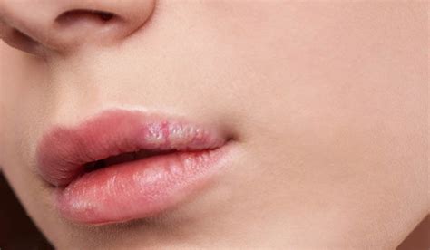 Red Ring Around Lips Causes Treatment And Prevention Its Charming Time