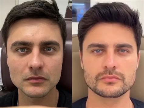 Veja O Antes E Depois De Famosos Que Fizeram Harmoniza O Facial Paipee