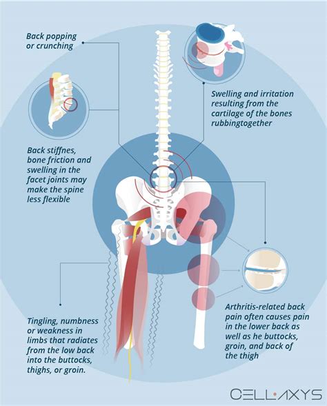 Diagram Of Common Back Bone Break Common Uses Of The Ishikawa Diagram