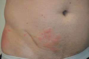 However, we do know that if infected individuals are recognized early and receive medical care in an. Shingles Treatment Boston & Wellesley | Krauss Dermatology