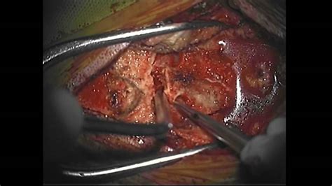 Thus, due to the location, these types of brain cancer are commonly associated with other symptoms, such as vision or hearing issues. Craniotomy for resection of 4th Ventricle Tumor - YouTube