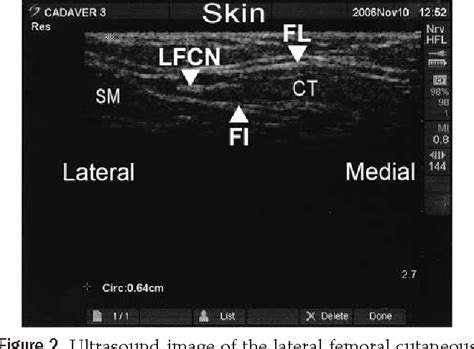 Figure 2 From Ultrasound Imaging Accurately Identifies The Lateral
