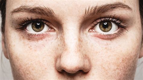 The Truth About Freckles