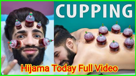 Hijama Therapy Hijama Cupping Videos Today Hijama For Skin Clear Youtube