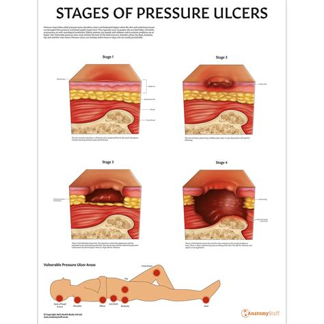 Pressure Ulcer Staging Chart Stages Of Pressure Injur