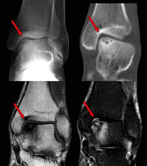 Ankle Cartilage Injuries London Uk Arthroscopic Key Hole