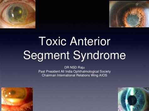 Causes Of Toxic Anterior Segment Syndrome