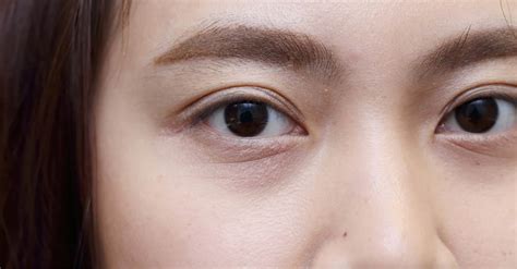 Sunken Eyebags How To Treat It Dream Plastic Surgery