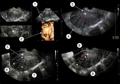 Consensus On Revised Definitions Of Morphological Uterus Sonographic